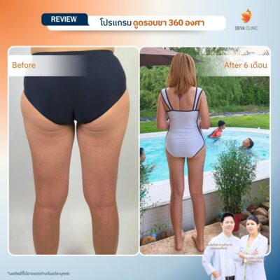 Before & After ดูดไขมันต้นขา 6
