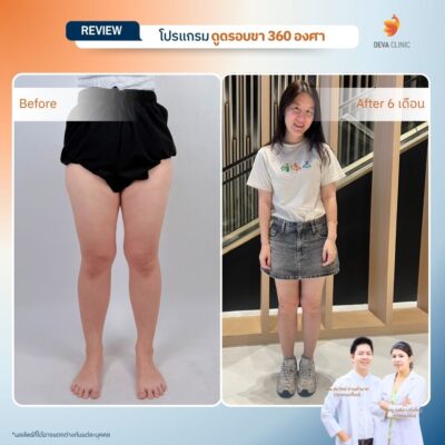 Before & After ดูดไขมันต้นขา 5