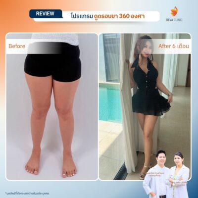 Before & After ดูดไขมันต้นขา 7