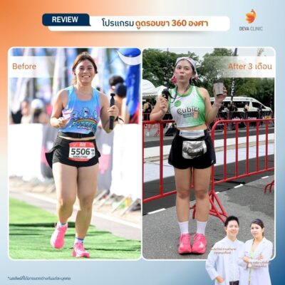 Before & After ดูดไขมันต้นขา 4