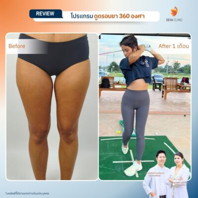 Before & After ดูดไขมันต้นขา 8
