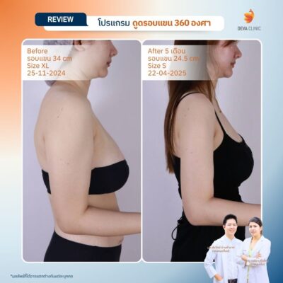 Before & After ดูดไขมันต้นแขน 8