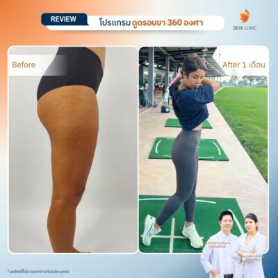 Before & After ดูดไขมันต้นขา 9