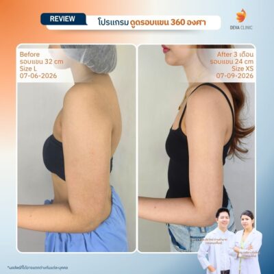Before & After ดูดไขมันต้นแขน 20