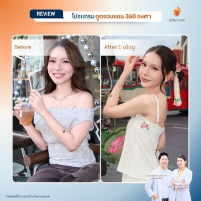 Before & After ดูดไขมันต้นแขน 4