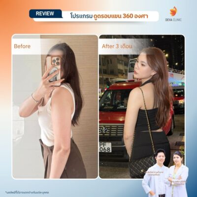 Before & After ดูดไขมันต้นแขน 7