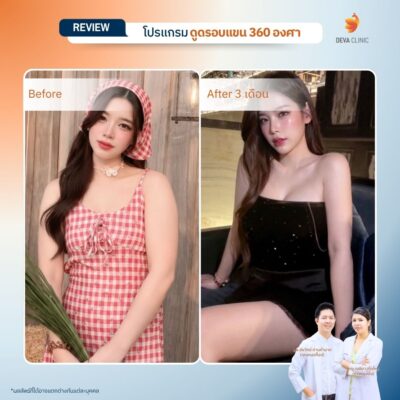 Before & After ดูดไขมันต้นแขน 2