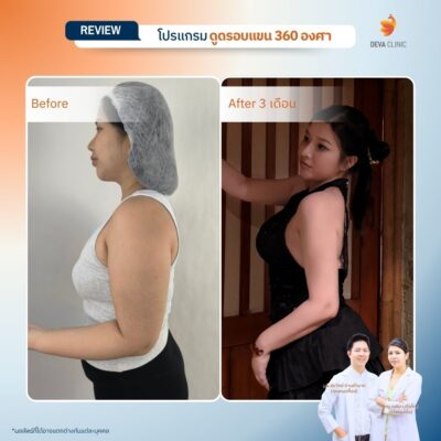 Before & After ดูดไขมันต้นแขน 3