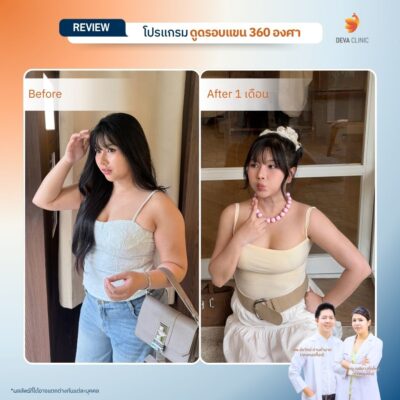Before & After ดูดไขมันต้นแขน 5