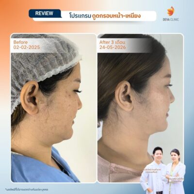 Before & After ดูดไขมันหน้า เหนียง 7