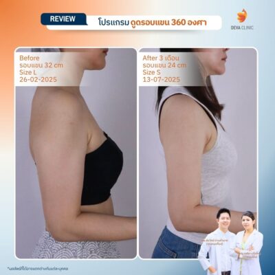 Before & After ดูดไขมันต้นแขน 9
