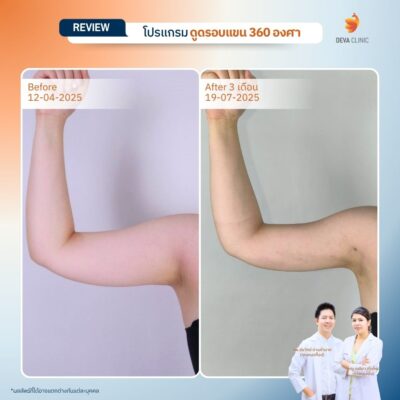 Before & After ดูดไขมันต้นแขน 10