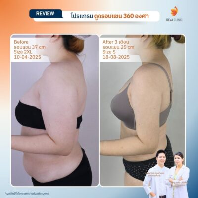 Before & After ดูดไขมันต้นแขน 11