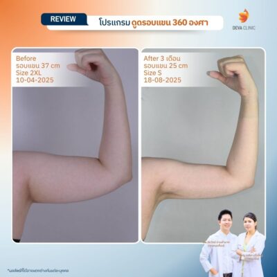 Before & After ดูดไขมันต้นแขน 12