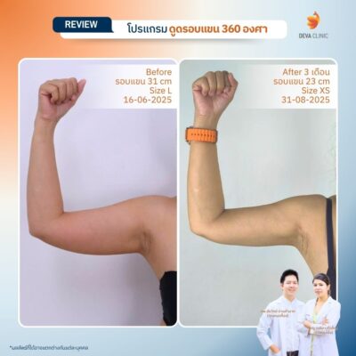 Before & After ดูดไขมันต้นแขน 14