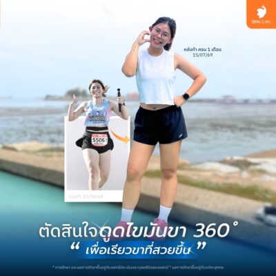 ตำแหน่งยอดฮิตที่นิยมดูดไขมันแบบซ่อนแผล - ต้นขา 1