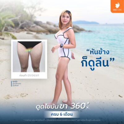 ภาพเปรียบเทียบก่อน-หลัง (Before & After) ดูดไขมันต้นขา 4