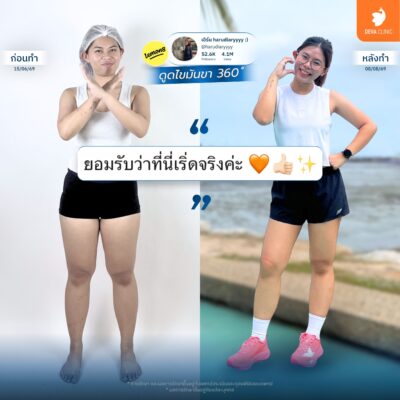 ภาพเปรียบเทียบก่อน-หลัง (Before & After) ดูดไขมันต้นขา 1