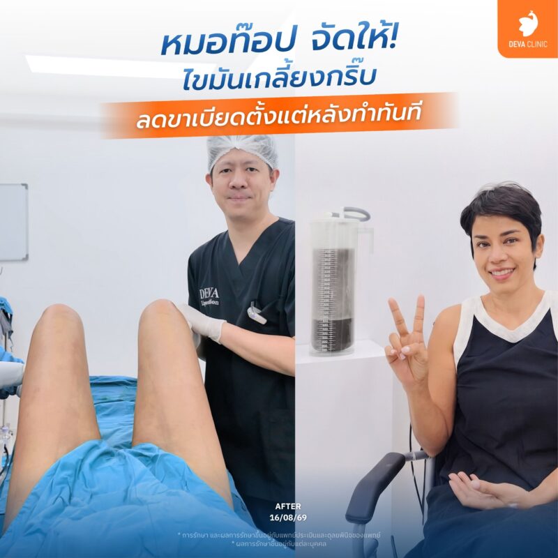 ดูดเกลี้ยง ไม่เป็นคลื่น - นพ.ชัยวิทย์ ดูดไขมัน