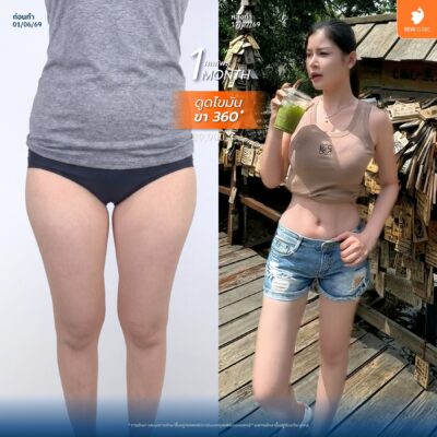 ตำแหน่งยอดฮิตที่นิยมดูดไขมันแบบซ่อนแผล - ต้นขา 6