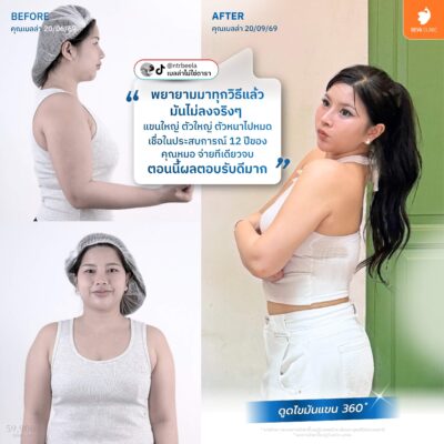 Before & After ต้นแขน 360 องศา 3
