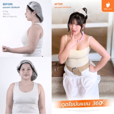 ดูดไขมันเทคนิคใหม่ ต้นแขน 360 องศา 3