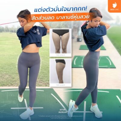ตำแหน่งยอดฮิตที่นิยมดูดไขมันแบบซ่อนแผล - ต้นขา 3