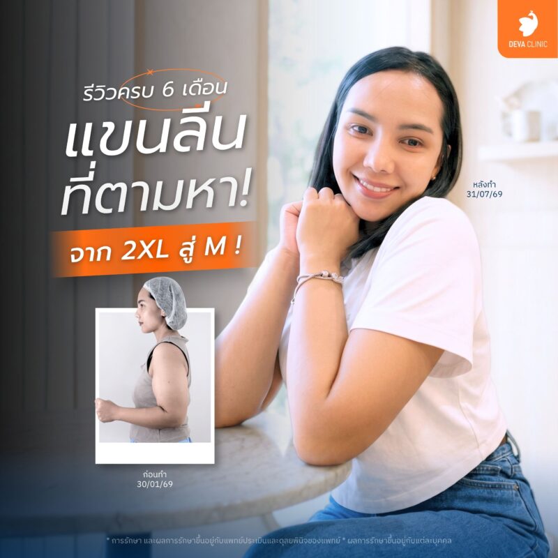 ดูดไขมันรอบแขนแบบ 360 องศา