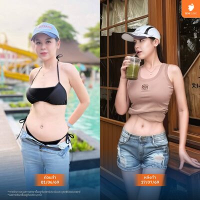 ภาพเปรียบเทียบก่อน-หลัง (Before & After) ดูดไขมันหน้าท้อง 1