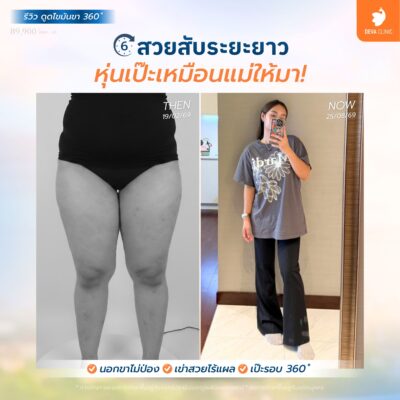 ทำไมต้องเลือกดูดไขมันเทคนิคใหม่ 360 องศา ที่ Deva Clinic 3
