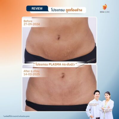 รีวิวผลลัพธ์หลังทำ ดูดไขมันกระชับผิว ราคา 8