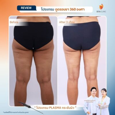 รีวิวผลลัพธ์หลังทำ ดูดไขมันกระชับผิว ราคา 7