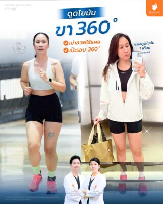 Before & After ต้นขา 360 องศา 1