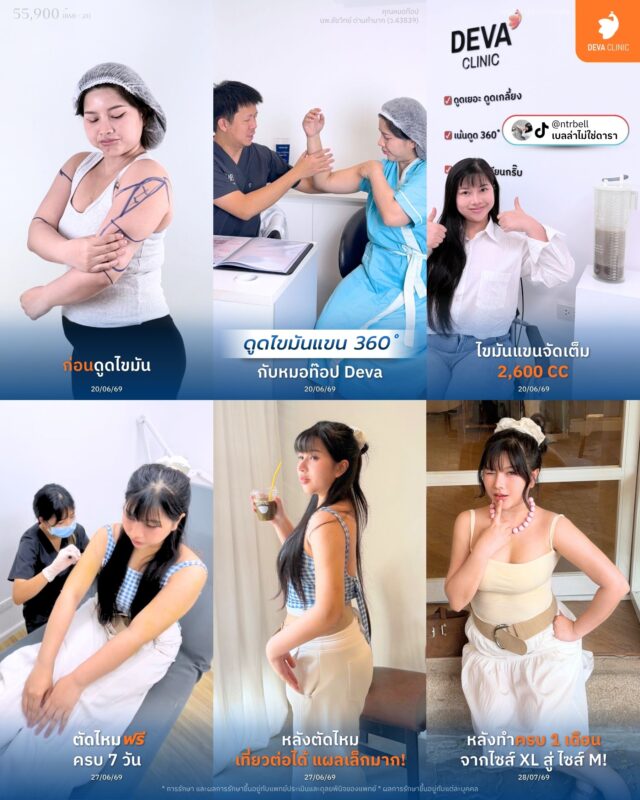 ต้นแขน 360 องศา - หมอดูดไขมันที่ไหนดี