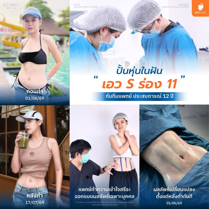 หน้าท้อง & เอว - หมอดูดไขมันที่ไหนดี