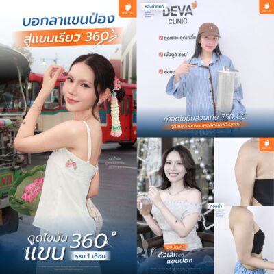 Before & After ต้นแขน 360 องศา 1